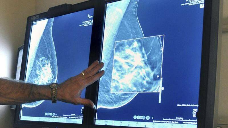 Indigenous breast cancer screening rates are almost 17 per cent lower than non-Indigenous rates.